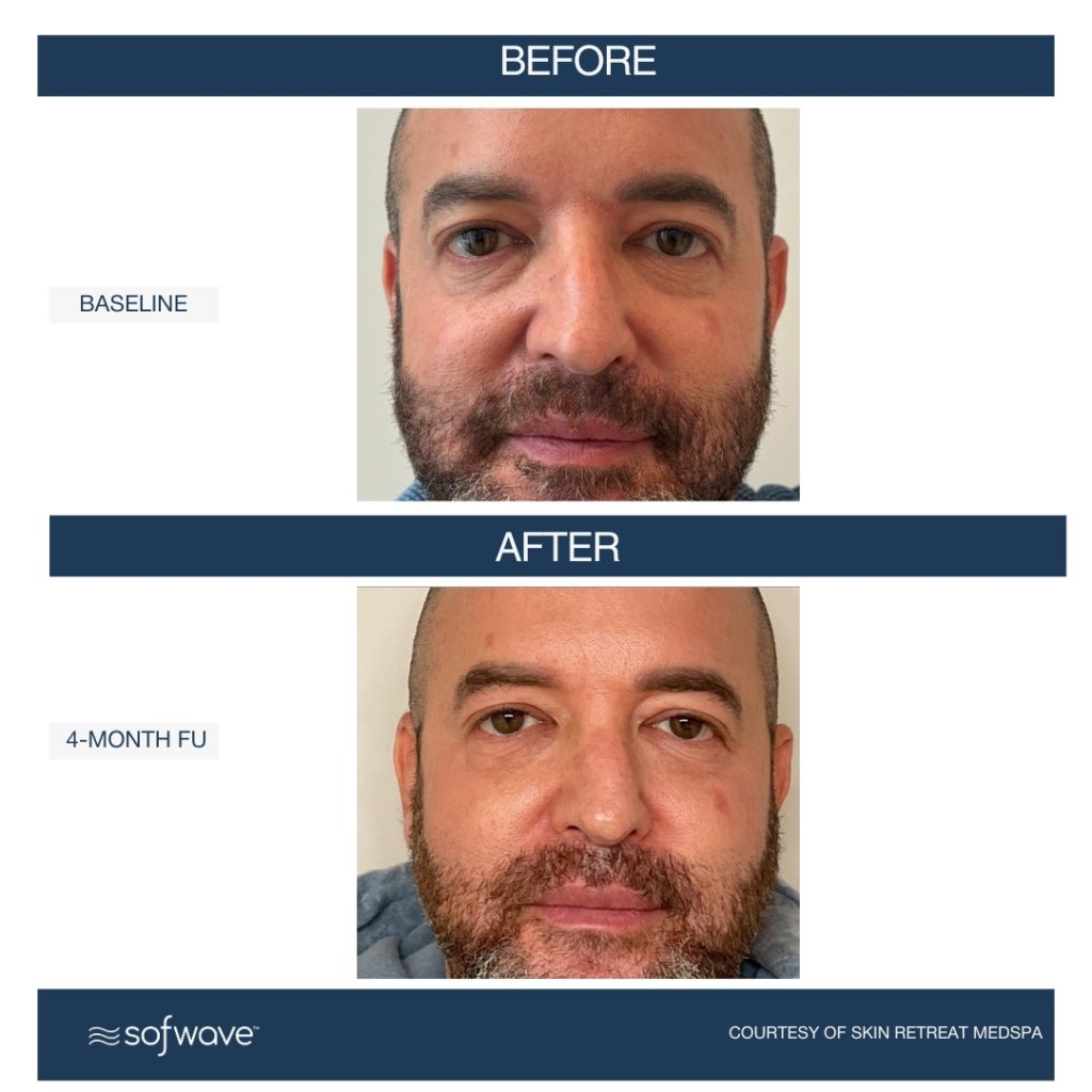 Sofwave under eye treatment results