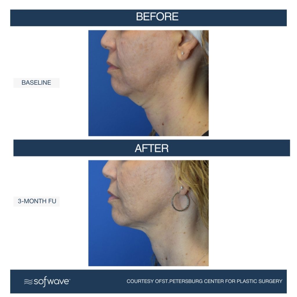 Sofwave full face and neck treatment