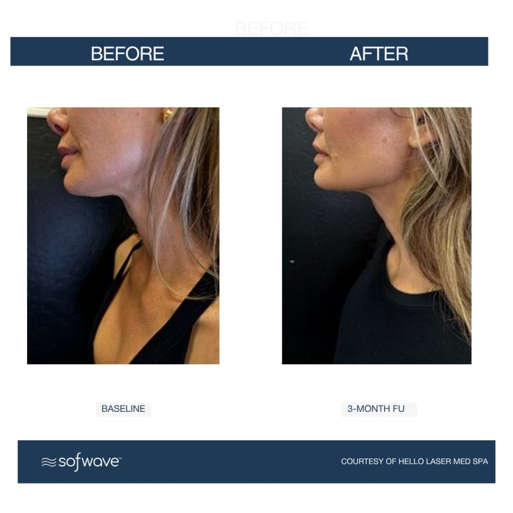 Sofwave submental treatment results