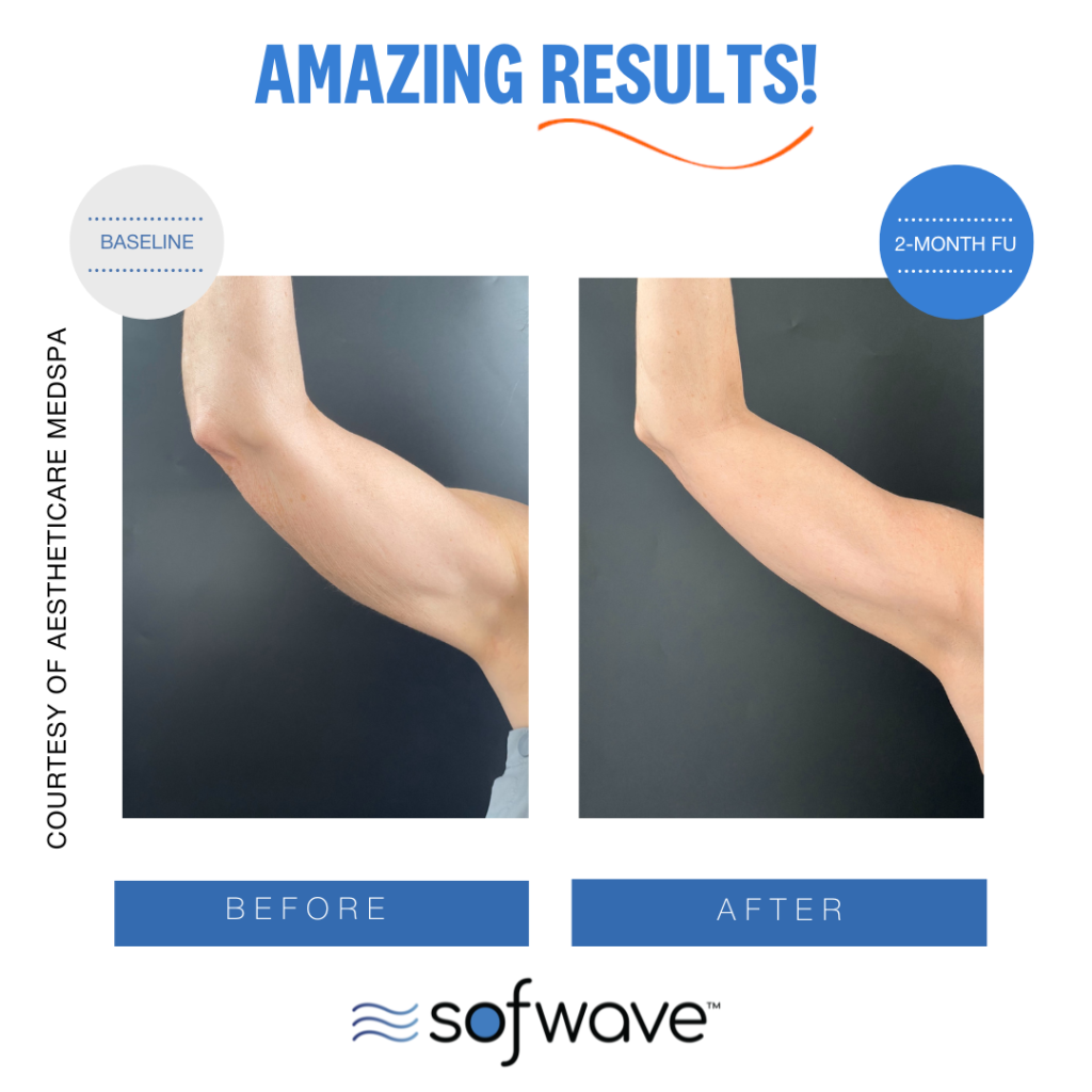Sofwave upper arm results