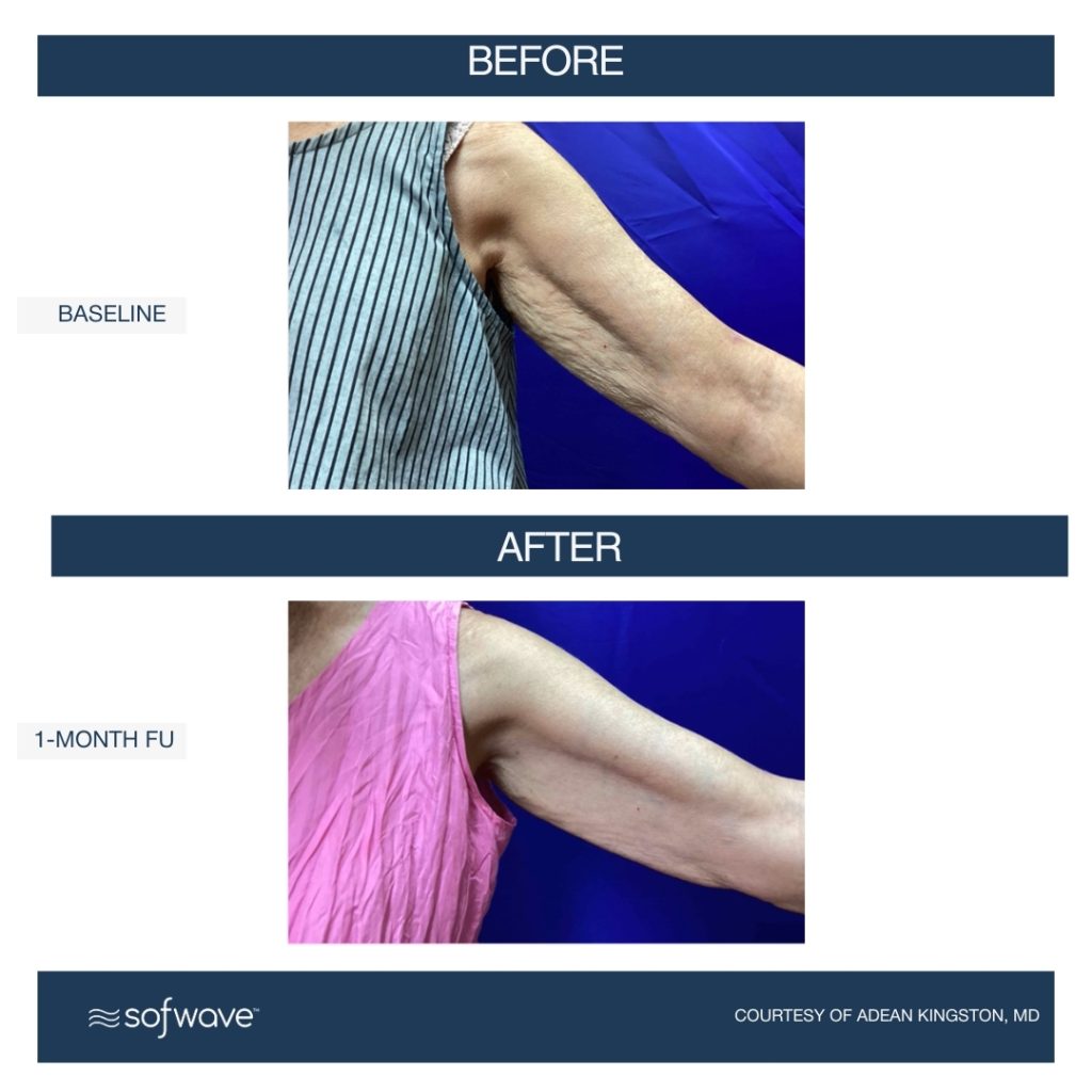 Sofwave upper arm treatment