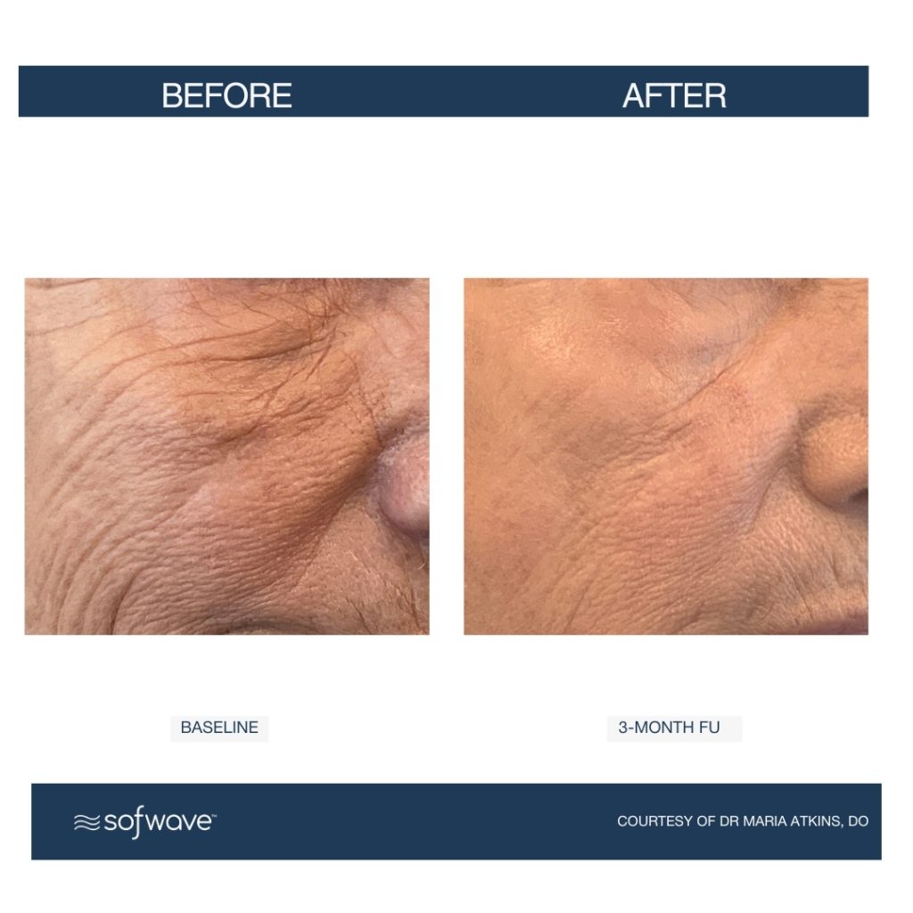 Sofwave under eye treatment