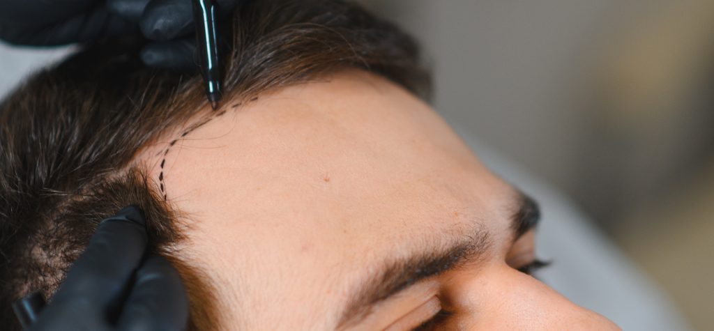Hair transplant services in Omaha at The Standard